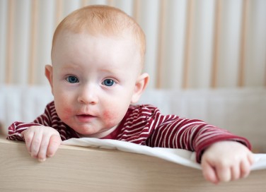 Dermatite atopica nei bambini: cause e rimedi