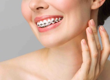 apparecchio dei denti