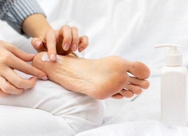 perché talloni si seccano, talloni secchi cause