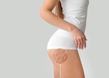 tipi di cellulite