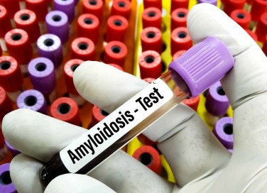 Amiloidosi