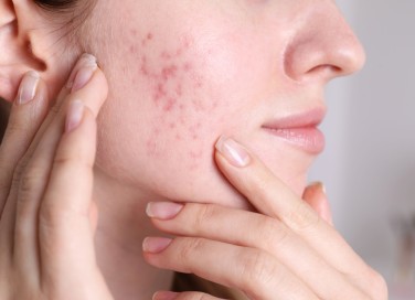 acne ormonale