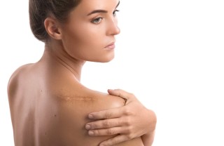 Come proteggere e guarire le cicatrici rimendi naturali, cicatrici, sole estivo