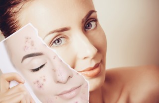 acne, segni