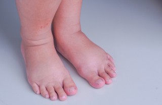 bambini piedini storti