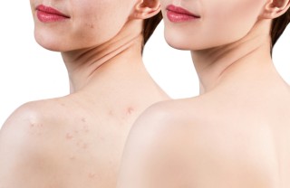 acne corpo acne corpo