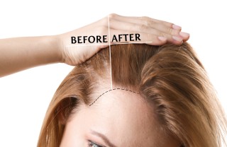 Patch capelli