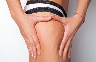 Cellulite