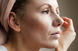 Acne donna Acne donna