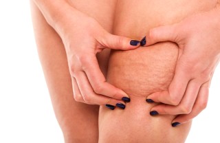 Cellulite Cellulite