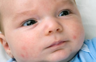 Acne neonatale