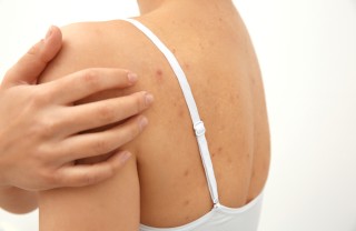 acne sulla schiena acne sulla schiena