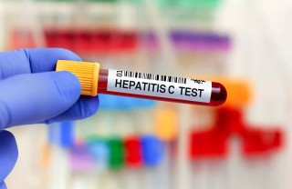 Epatite C: sintomi, cause e cure