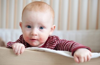 Dermatite atopica nei bambini: cause e rimedi