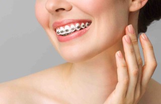 apparecchio dei denti