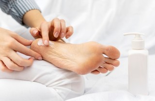 perché talloni si seccano, talloni secchi cause