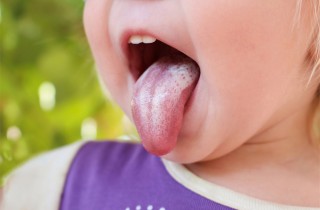 Mughetto nei bambini: sintomi e prevenzione