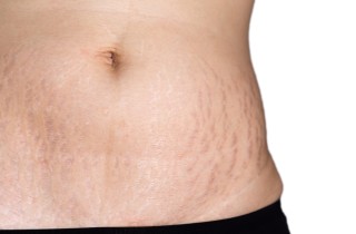 Come togliere le smagliature rosse