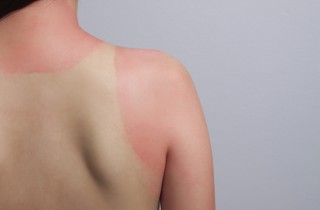 Abbronzatura da muratore: 7 rimedi per togliere l'effetto zebrato