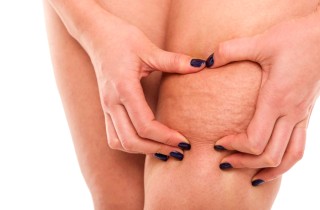 3 consigli per combattere la ritenzione idrica