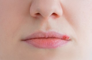 L'herpes labiale in gravidanza è pericoloso?