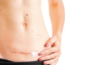 Perché massaggiare la cicatrice del cesareo è importante?