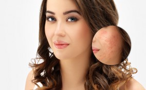 cicatrici da acne, pelle, rimedi naturali