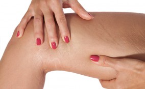 Smagliatura interno coscia