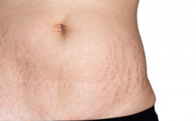 come togliere smagliature rosse, smagliature rosse, smagliature rimedi