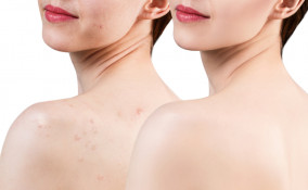 acne corpo
