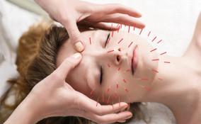 Agopuntura facciale