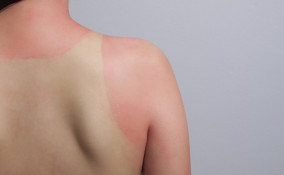 abbronzatura muratore rimedi, abbronzatura muratore