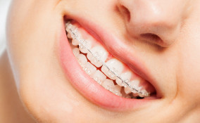 scegliere apparecchio dentale