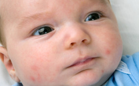 Acne neonatale
