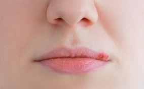 Herpes labiale in gravidanza