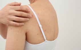 brufoli sulle braccia