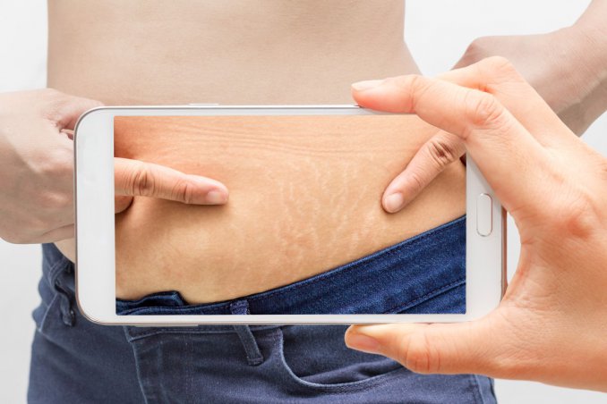 smagliature, pelle smagliata, rimedi naturali