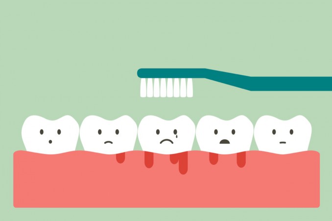 rimedi naturali, gengive infiammate, sollievo
