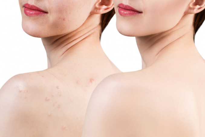 acne corpo